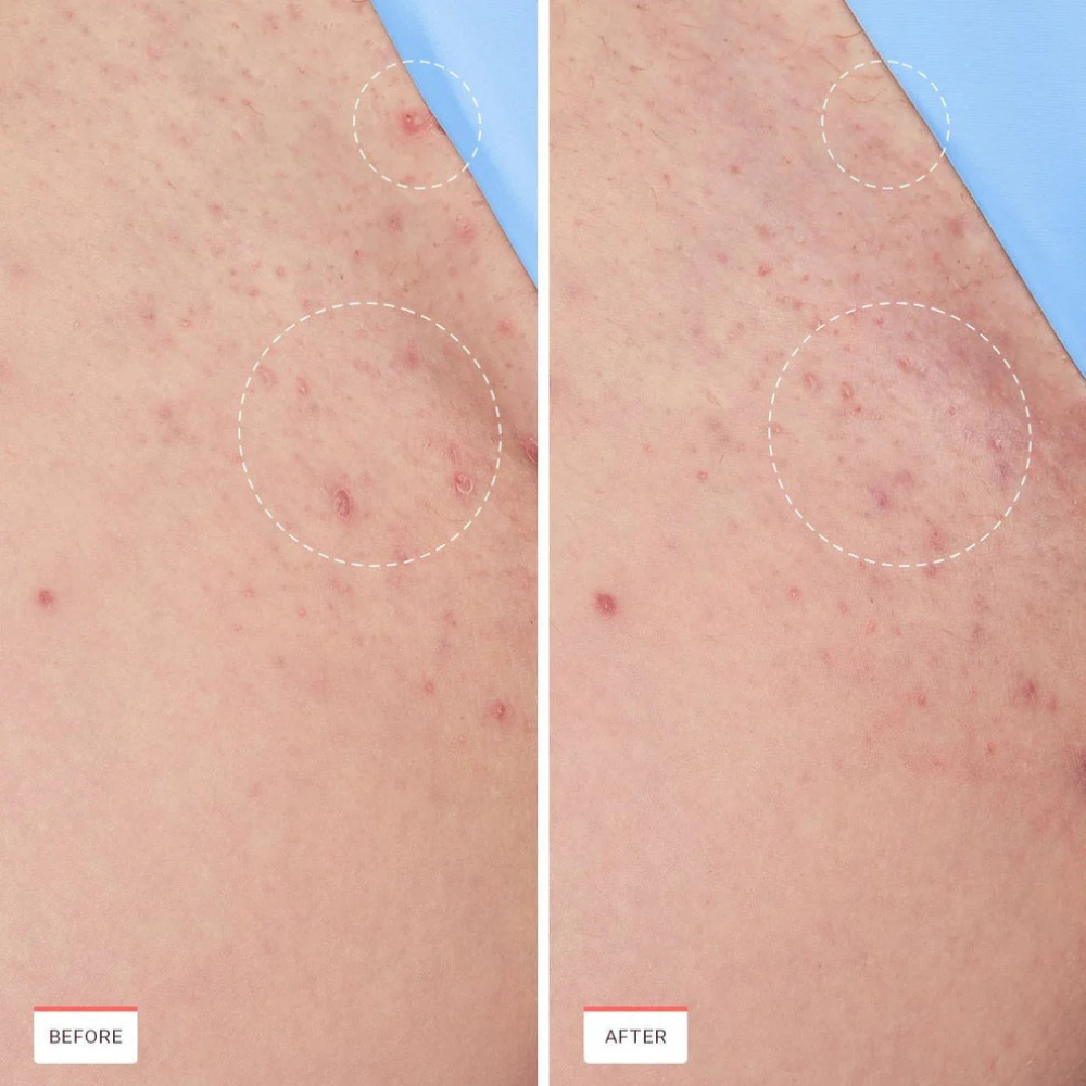 Verlu® Ingrown Relief