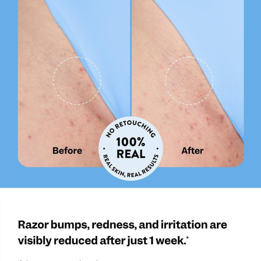 Verlu® Ingrown Relief
