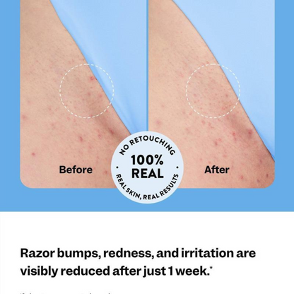 Verlu® Ingrown Relief
